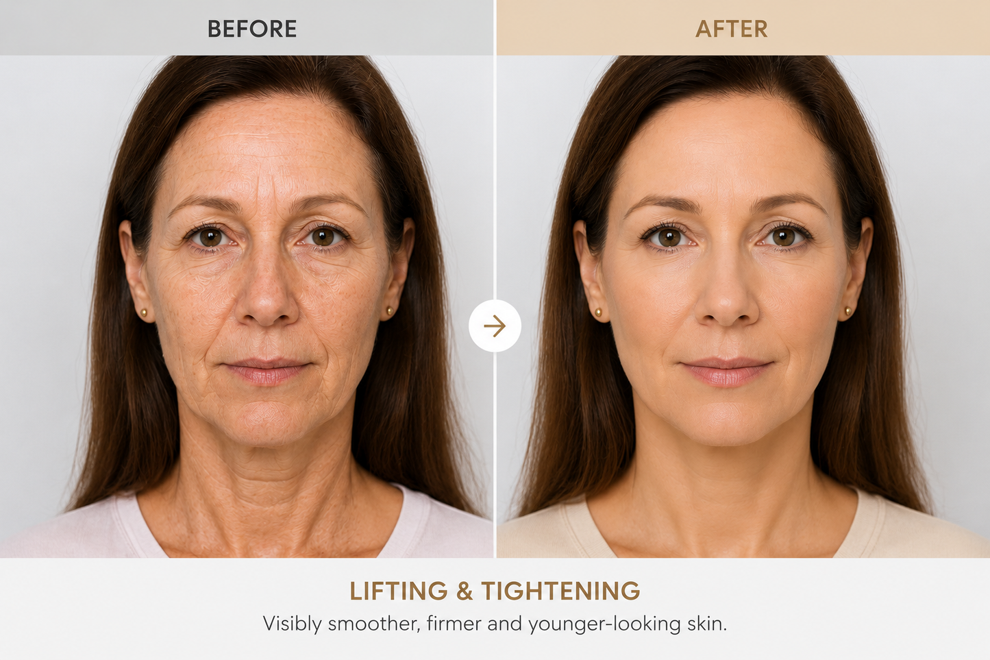 PhotoLift RF Pro